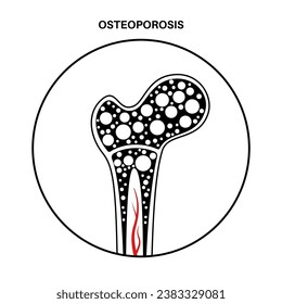 Osteoporosis disease. Systemic skeletal disorder, loss of bone mineral density. Increased risk of hip fracture, morbidity and mortality in the elderly. Deterioration of bone tissue vector illustration