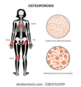 Osteoporosis disease. Systemic skeletal disorder, loss of bone density. Normal and unhealthy bones in the human body. Increased risk of fractures. Deterioration of bone tissue vector flat illustration