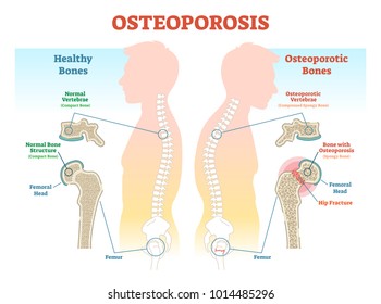 Osteoporosis examples vector illustration diagram with bone density. Medical scheme and educational information. 