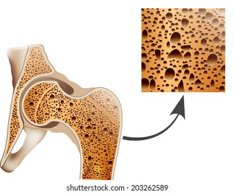 Osteoporosis in femur bone, human bone anatomy. 