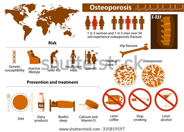 Osteoporosis Health Problems Medicine Medical Infographics Stock Vector Royalty Free 335819597 