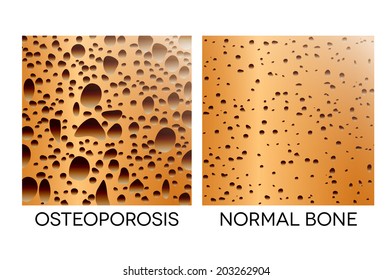 Osteoporosis, human bone anatomy. Medical illustration healthy bone and unhealthy bone.