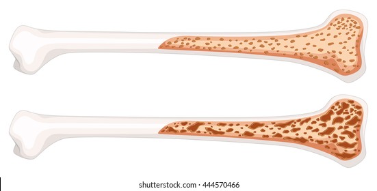 Osteoporosis in human bone illustration