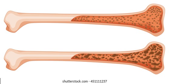 Osteoporosis en la ilustración ósea humana