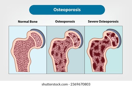 Osteoporosis en niveles, huesos sanos, osteoporosis frente a osteoporosis grave