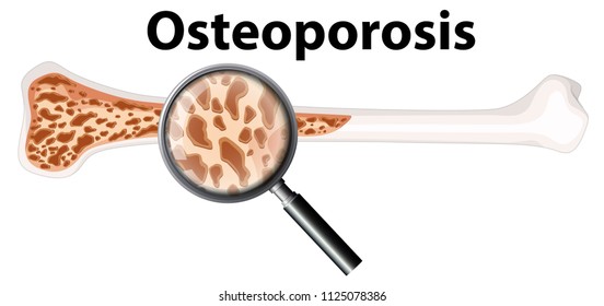 Osteoporosis and Magnifying Glass  illustration