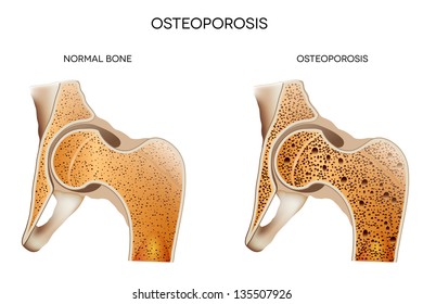 Osteoporosis. Medical illustration healthy bone and unhealthy bone- osteoporosis. Osteoporosis may leads to bone fracture.