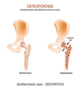 Osteoporosis. articulación normal de la cadera y hueso con trastorno esquelético caracterizado por baja masa ósea. riesgo de fractura de fémur. diferencia y comparación