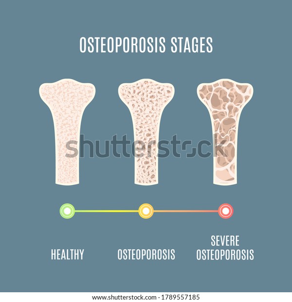 Osteoporosis process infographic of\
bone tissue close-up with different density. Skeletal system\
disease stages. Senior osteopathy medical concept. Vector\
illustration.