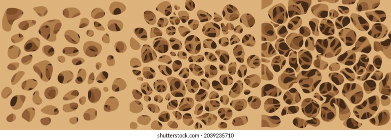 Osteoporosis progresses from healthy to sick - vector graphic with 4 Layers