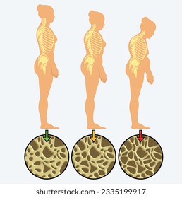 Osteoporosis - the progression of osteoporosis and vertebral fractures as a woman ages.