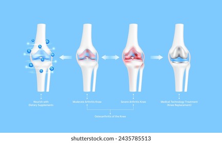 Osteoporosis or severe moderate arthritis joint. Leg bone cartilage ligament. Nourish with dietary supplements and Innovation medical technology treatment. Knee replacement surgery or implant. Vector.