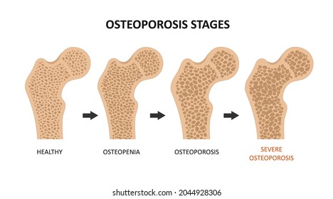 Estadios de osteoporosis. Estructura espontánea ósea ilustración vectorial, normal, osteopenia y osteoporosis