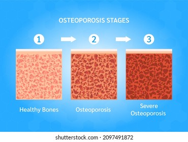 Osteoporosis Stages. Bone Structure Normal And Osteoporosis. Medical Check Up Health Concept. Isolated On A Blue Background. Vector EPS10 Illustration.