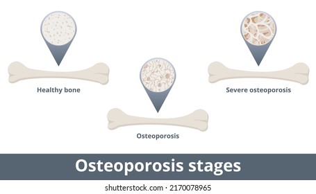 8,156 Infographic osteoporosis Images, Stock Photos & Vectors ...