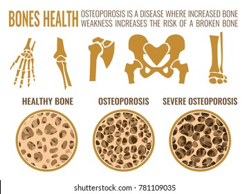 Osteoporosis stages image. Osteoporosis bone and healthy bone in comparison isolated on a white background. Vector illustration useful for medical, educational or scientific graphic design.