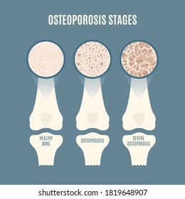 Osteoporosis Stages Set Bone Mass Loss Stock Vector (Royalty Free ...