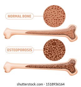 Osteoporosis vector design illustration isolated on white background