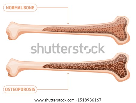 Osteoporosis vector design illustration isolated on white background
