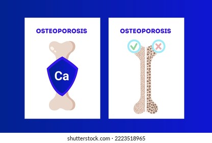 Ilustración vectorial de la osteoporosis. Afiche ortopédico médico con una ilustración de huesos con eslogan ostoporosis. Pérdida de masa ósea. Prevención de la enfermedad ósea y ósea