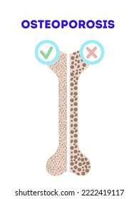 Osteoporosis vector illustration. Sick and healthy bone. Medical orthopaedic poster with an illustration of bones with slogan ostoporosis.Loss of bone mass. Prevention of bone and skeletal disease