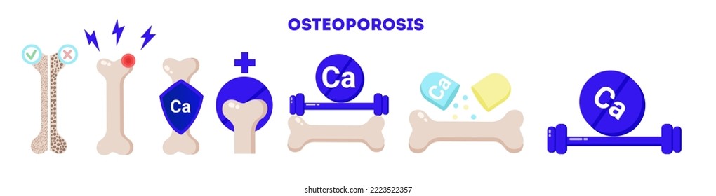 Osteoporosis vector illustrations set. Medical orthopaedic illustrations of bones and calcium.Loss of bone mass. Prevention of bone and skeletal disease. Sick and healthy bone