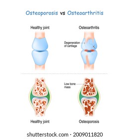 Osteoporosis vs Osteoartritis. comparación y diferencia entre la enfermedad articular sana y la enfermedad articular degenerativa, y la articulación con masa ósea baja. Sección transversal del hueso esquelético