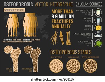 Osteoporosis in the world. Medical infographic poster. Healthcare, medicine and early prevention concept. Landscape format. Vector illustration with useful facts and advices.