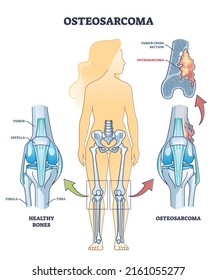 Osteosarcoma bone tumor as osteogenic sarcoma skeleton cancer outline diagram. Labeled educational medical scheme with human knee anatomy or femur cross section vector illustration. Healthy comparison