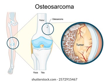 Osteosarcoma. Malignant bone tumor. Human leg with Bone cancer. Close-up of a knee joint and bone tissue with tumor. Vector illustration. Medical poster