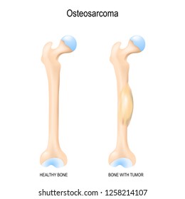 Osteosarcoma. Osteogenic sarcoma is a cancerous tumor in a bone. malignant neoplasm. Two human bones: healthy femur and bone with osteosarcoma. Vector illustration for biological, science, medical use