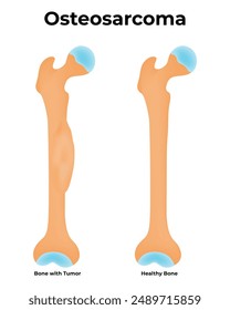 Osteosarcoma Science Design Vector Illustration Diagram