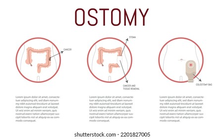 Ostomy process in case of cancer, once detected, it is sectioned and the bag is placed.