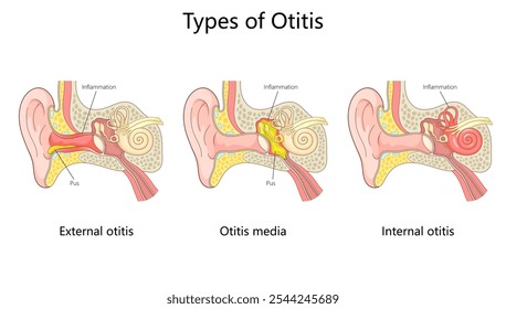 otitis ear infections external otitis, otitis media, and internal otitis with inflammation and pus buildup diagram hand drawn schematic vector illustration. Medical science educational illustration