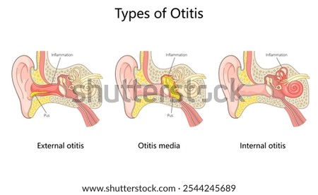 otitis ear infections external otitis, otitis media, and internal otitis with inflammation and pus buildup diagram hand drawn schematic vector illustration. Medical science educational illustration