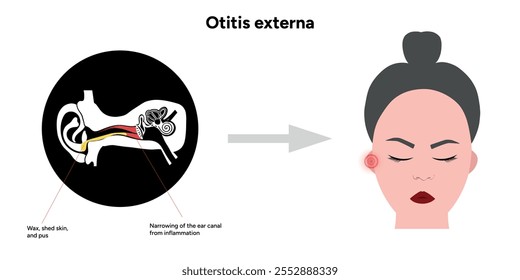 Otitis externa anatomy ear disease inflammation