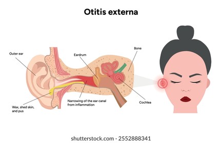 Otitis externa anatomy ear disease inflammation