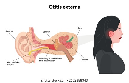 Otitis anatomía externa Enfermedad del oído inflamación