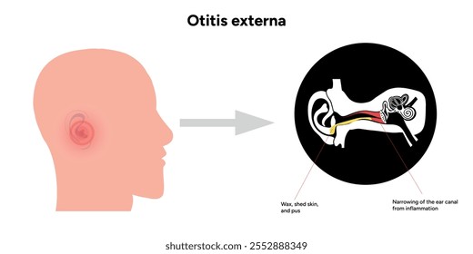 Otitis externa anatomy ear disease inflammation