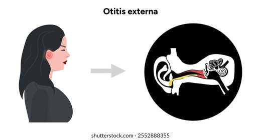 Otitis externa anatomy ear disease inflammation