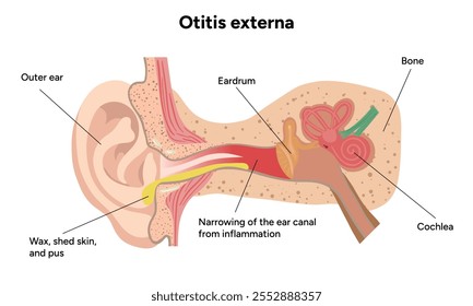 Otite externa anatomia doença do ouvido inflamação