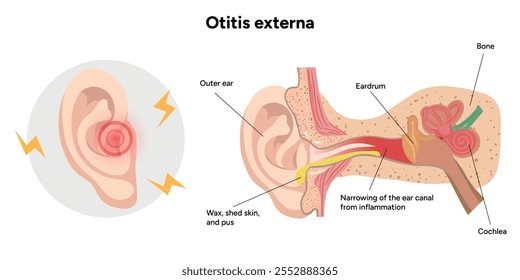 Otite externa anatomia doença do ouvido inflamação