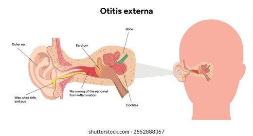 Otitis anatomía externa Enfermedad del oído inflamación