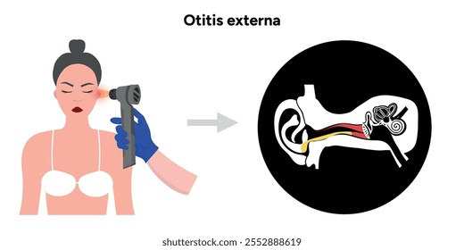 Otitis externa anatomy ear disease inflammation and check up in doctor appointment