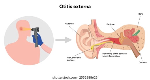 Otitis externa anatomy ear disease inflammation and check up in doctor appointment