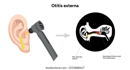 Otitis anatomía externa Enfermedad del oído inflamación y chequeo en cita médica