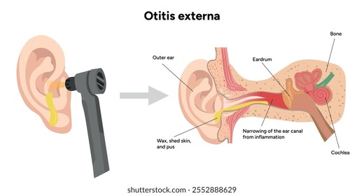 Otitis anatomía externa Enfermedad del oído inflamación y chequeo en cita médica