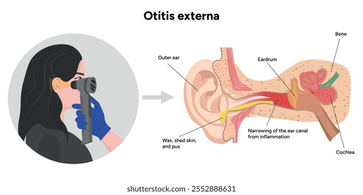 Otitis externa anatomy ear disease inflammation and check up in doctor appointment