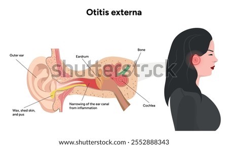 Otitis externa anatomy ear disease inflammation