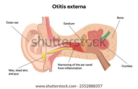 Otitis externa anatomy ear disease inflammation